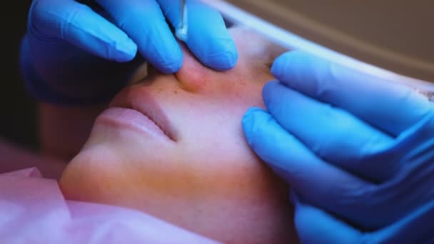 Facial cleansing at the beautician. Squeezing pimples on the nose with a needle and magnifier. Close-up face. — Stock Video