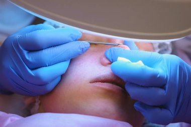 Mekanik Şevval özçelik güzellik, yüz temizleme. Güzellik uzmanı tıbbi iğne ile hastanın burun sivilce sıkmak.