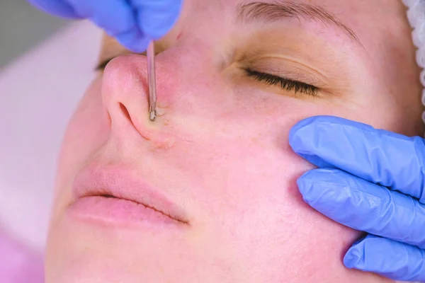 Limpeza mecânica do rosto no esteticista. Cosmetologist espremer a acne no nariz da agulha médica do paciente . — Fotografia de Stock