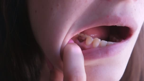 카레시놀-포르말린 페이스트를 사용하여 충치가 있는 분홍색 치아. — 비디오