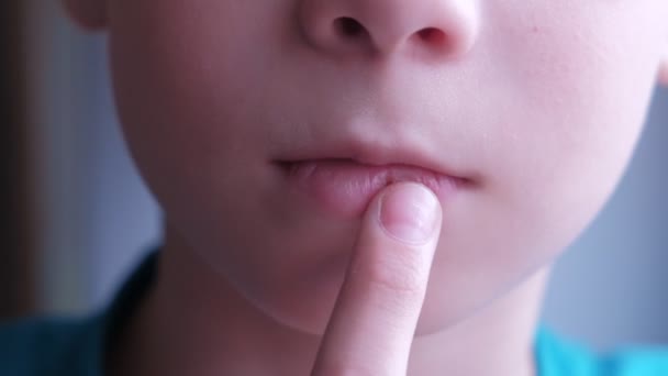 Junge berührt Herpes wund an der Lippe, Mund Nahaufnahme. — Stockvideo