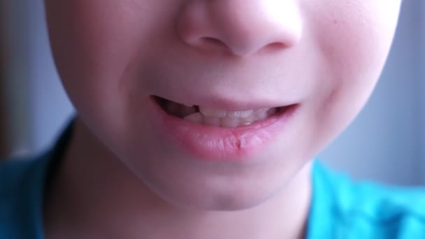 Herpes virus on human lips. Child boy with herpes sore on the lip mouth closeup. — Stock Video