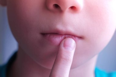 Child boy touches herpes sore on the lip, mouth closeup. clipart