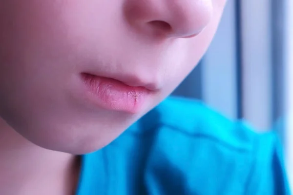 Niño chico lame por lengua su agrietado labios, boca primer plano . — Foto de Stock