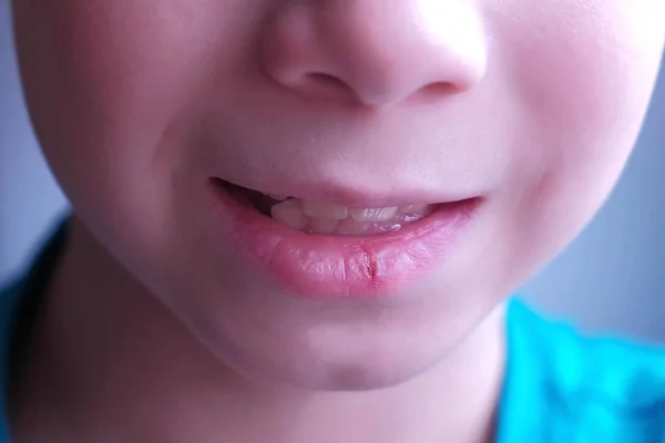 Virus del herpes en labios humanos. Niño con herpes en el labio boca primer plano . — Foto de Stock