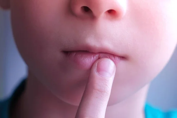 Child boy touches herpes sore on the lip, mouth closeup. — Stock Photo, Image