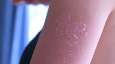Omuzuv güneş yanığı deri soyma ile kadın, closeup görünümü.