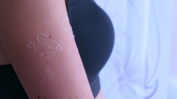 Mulher com pele descascada de queimadura solar UV no ombro, close-up . — Vídeo de Stock