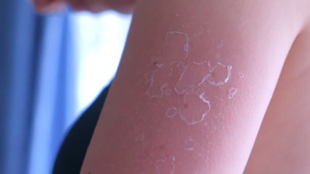 Woman with peeling skin from UV sunburn on shoulder, closeup view. — Stock Video