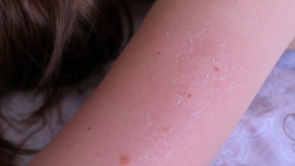 Close-upweergave van verbrande schil huid van UV-zonnebrand bij de hand, close-up-weergave. — Stockvideo