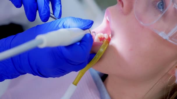 Primo piano procedura di pulizia dei denti ultrasonici bocca in odontoiatria per la giovane donna . — Video Stock