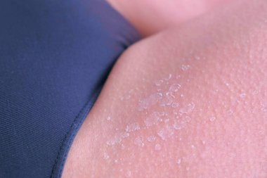 Uv güneş yanığı bacak, closeup görünümü yanmış peeling cilt closeup görünümü.