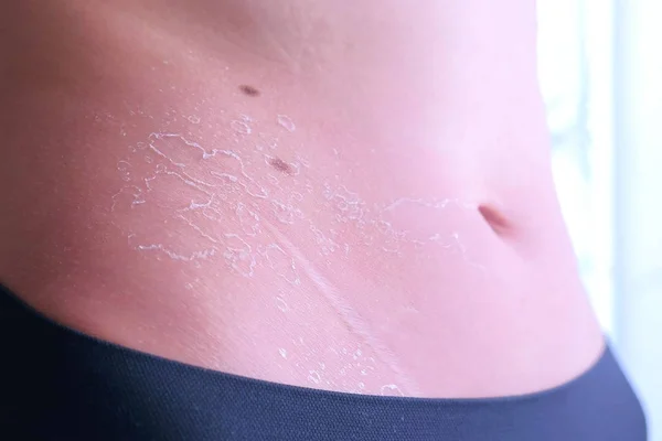 Wanita dengan kulit terbakar dari sinar matahari UV pada perut, pandangan tertutup . — Stok Foto