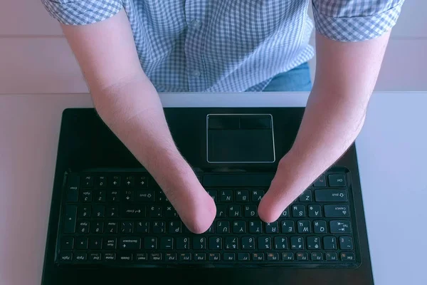 Behinderter Mann mit amputierten Stummelhänden tippt auf Laptop, Nahaufnahme von oben. — Stockfoto