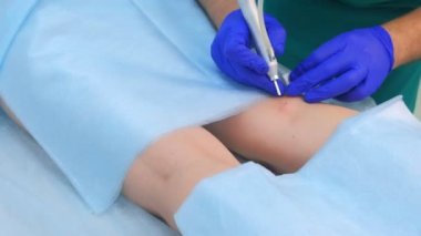 Doktor cerrah hasta bacağında lazer kullanarak doğum lekelerini kaldırır, eller yakın.