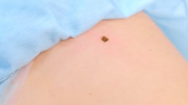 Hasta sırtında lazer alındıktan sonra çıkarılan köstebeğin sazlığı, yakın çekim görünümü.