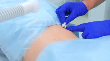 Kaldırılan köstebeba yeşil antiseptik uygulayan cerrah doktor.