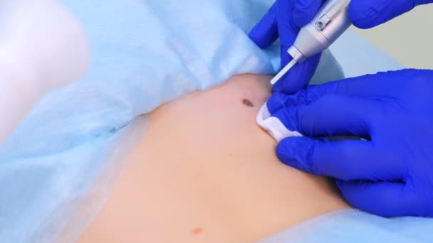 Médico cirujano extirpando lunar usando rayo láser en la espalda del paciente, vista de primer plano . — Vídeos de Stock