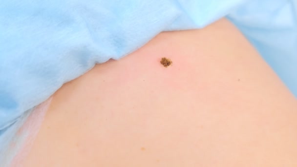 More di talpa rimossa dopo la rimozione laser sulla schiena del paziente, vista da vicino . — Video Stock