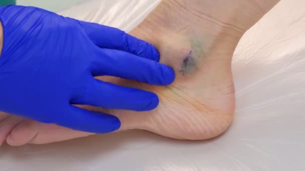 Surgeon palpates leg around suture after surgery to remove ankle hygroma. — Stock Video