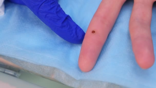 Öm av bort vårta efter laser borttagning på patientens finger, närbild Visa. — Stockvideo