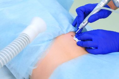 Doktor cerrah operasyonu hasta sırt, closeup görünümü üzerinde lazer kullanarak köstebek kaldırır.