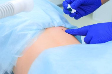 Kaldırılan köstebeba yeşil antiseptik uygulayan cerrah doktor.