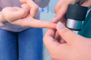 Cerrah çıkarmadan önce dermatkop büyüteç kullanarak parmak siğil inceler.