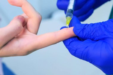 Cerrah lazer siğil çıkarmadan önce hastaya enjeksiyon lokal anestezi verir.