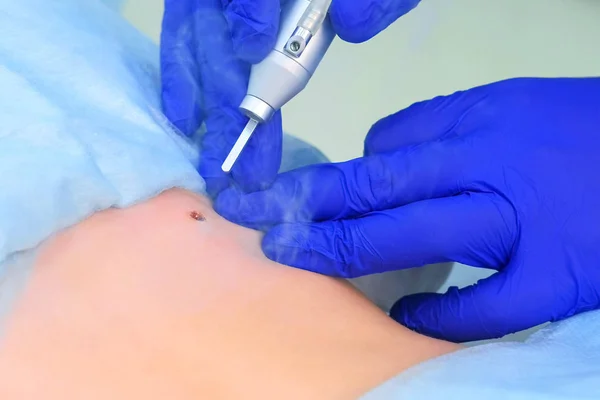 Processo de remoção de toupeira usando laser no paciente de volta pelo cirurgião, vista close-up . — Fotografia de Stock