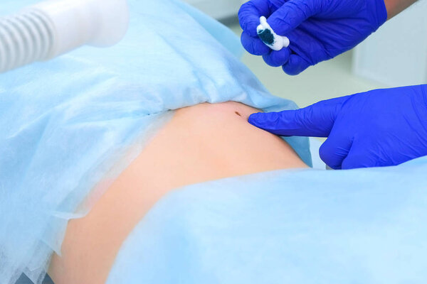Surgeon doctor applying green antiseptic on removed mole on patient back.