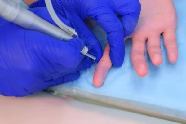 Surgeon removing wart on patients finger using laser, hands closeup. — Stock Photo, Image