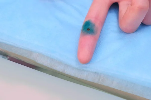 Médico cirujano aplicando antiséptico verde en la verruga eliminada en el dedo del paciente . — Foto de Stock