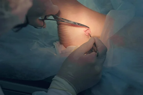 Cirurgião fazendo cirurgia de remoção de higroma do tornozelo usando ferramentas médicas no hospital. — Fotografia de Stock