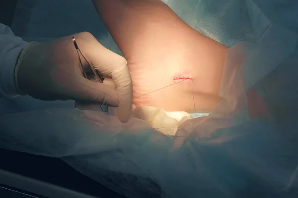 Cirurgião sutura tornozelo durante a cirurgia com pontos puros após a remoção de higroma. — Fotografia de Stock