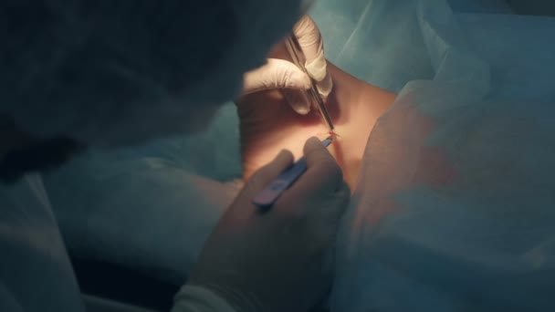 Cirurgião faz uma incisão com bisturi na perna no tornozelo para remover higroma comum . — Vídeo de Stock
