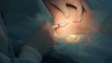 Cerrah, ameliyat sırasında yarayı dikmek için lokal anestezi ilacı veriyor..