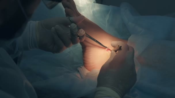 Kirurg gör kirurgi av avlägsnande fotled hygroma på sjukhus kontroll sår. — Stockvideo