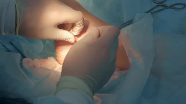 Chirurg stehy kotník po operaci a kravaty uzel s self-absorbovatelné nitě. — Stock video