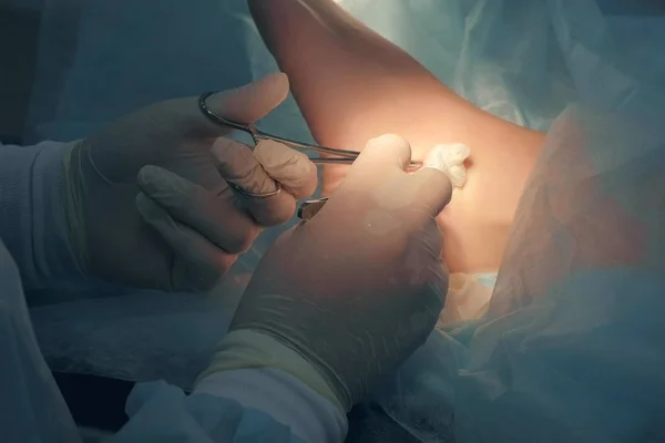 Хірург робить операцію з видалення гігроми щиколотки в лікарні в операційній . — стокове фото