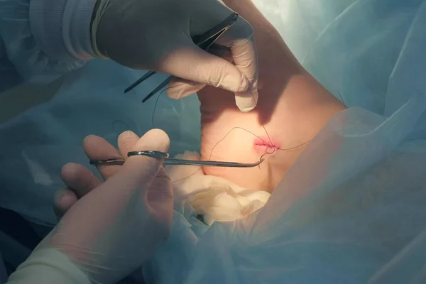 Kirurg suturer fotled under operation med snyggt stygn efter att ha tagit bort hygroma. — Stockfoto