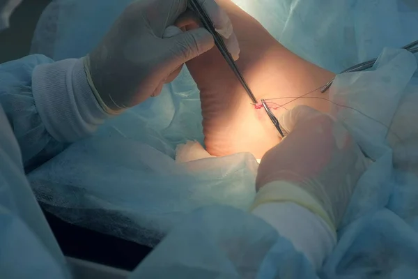 Cirurgião costura tornozelo na perna durante a cirurgia com fios auto-absorvíveis. — Fotografia de Stock