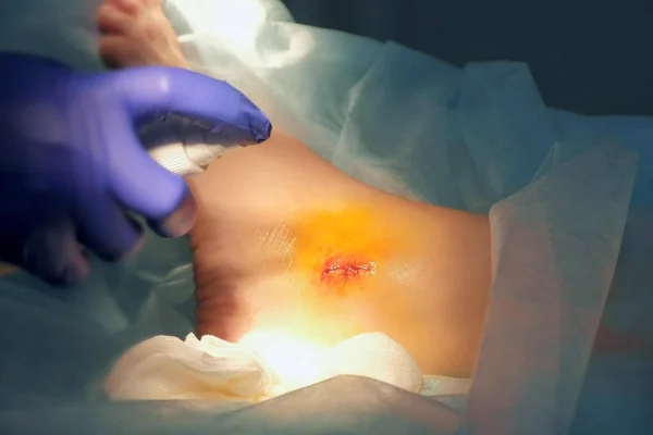 Chirurg sprüht Jod-Antiseptikum auf Naht am Knöchel des Patienten nach der Operation. — Stockfoto