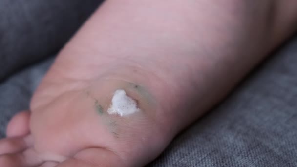 Desinfecterende wond na laserverwijdering op voet waterstofperoxide. — Stockvideo