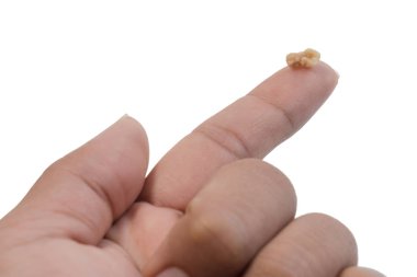 İşaret parmağındaki bademcik taşı ya da bademcik taşı beyaz arka planda izole edilmiş. Bademcik taşları, bademciklere saplanmış enkaz yığınlarıdır..