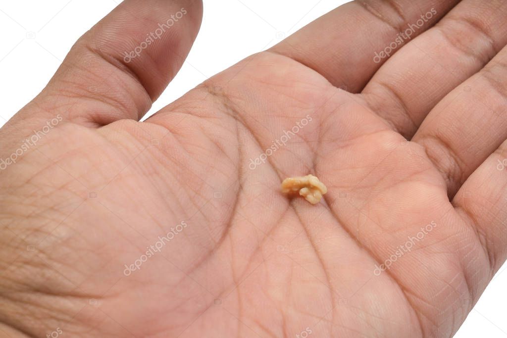Tonsil Stone or Tonsillolith on the palm isolated on white background. Tonsil stones are hard deposits of debris that have lodged in tonsils.