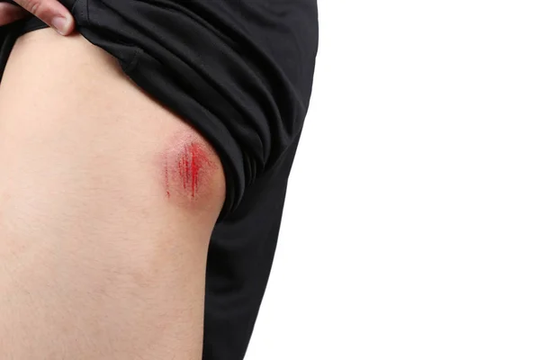 Bruised Wound Injury Skin Butt Skin Bum Asian Young Boy — Stock Photo, Image