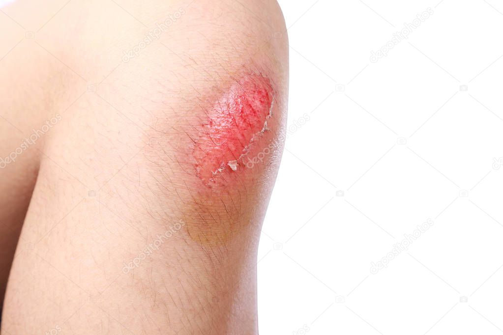 Asian boy got accident painful wound, scraped or injured on knee in football game. Close up of bleeding scraped after run accident isolated on white background.