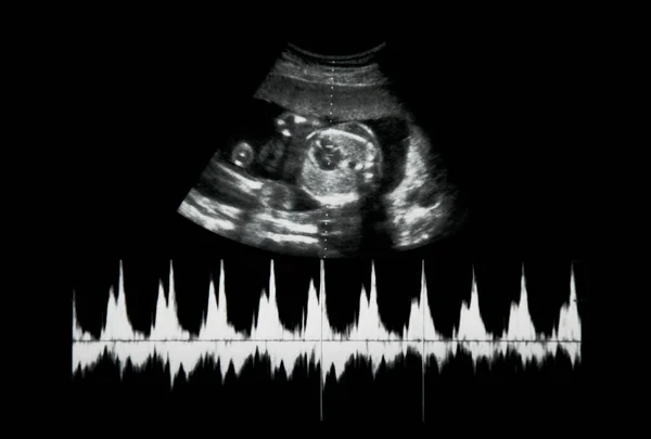 Ultra Som Bebê Útero Mãe — Fotografia de Stock