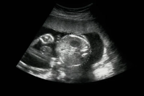 Bebeğin ultrasonu anne karnında..